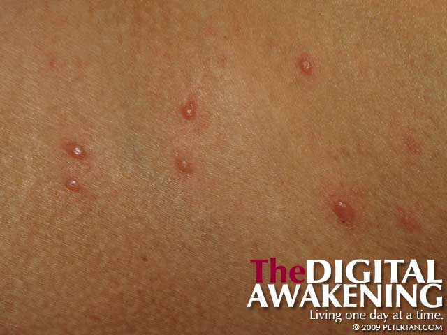 Chickenpox Photos – Peter Tan – The Digital Awakening